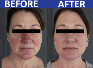 B4 and After of client with Rosacea